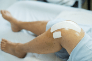 GdB bei Arthrose: Sind ein/beide Knie betroffen, kann der Behinderungsgrad bei mehreren erkrankten Gelenken höher ausfallen.